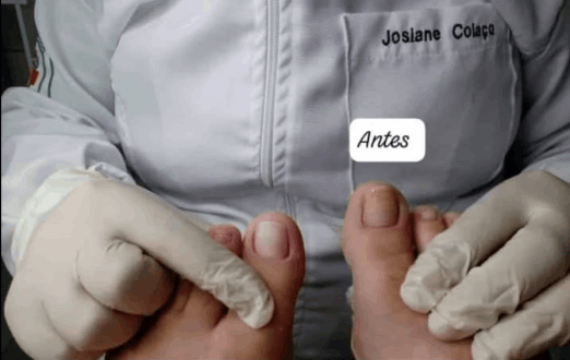 Cuide dos seus pés com os melhores tratamentos de podologia no Tatuquara. Avaliação gratuita e profissionais qualificados!
